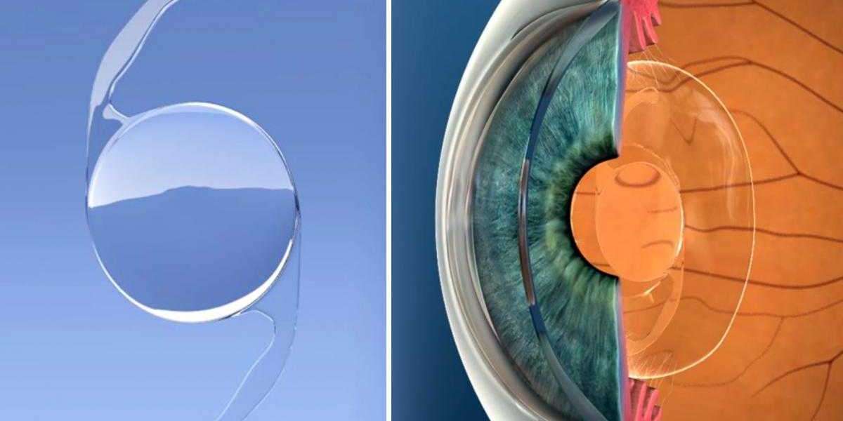 Intraocular Lens Market Insights, Trends, Growth, Outlook, Share, Dynamics, Research Reports