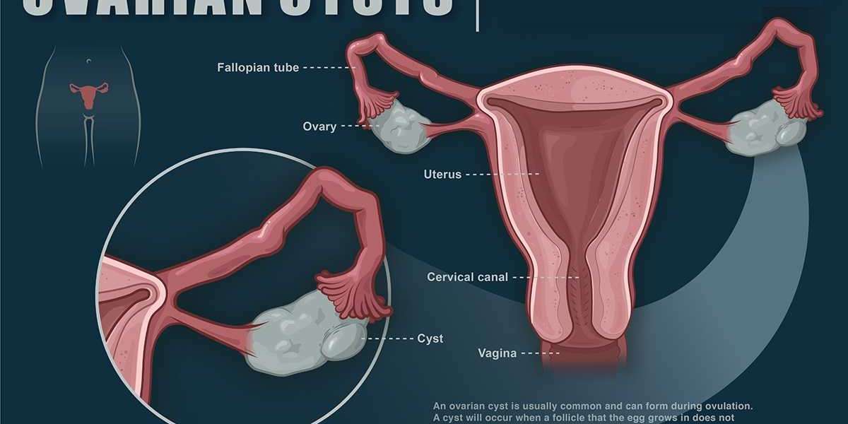 Ovarian Cysts Market Insights Report on Efficient and Efforts to Reduce in-house Operational Costs